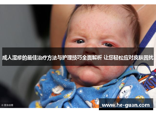成人湿疹的最佳治疗方法与护理技巧全面解析 让您轻松应对皮肤困扰