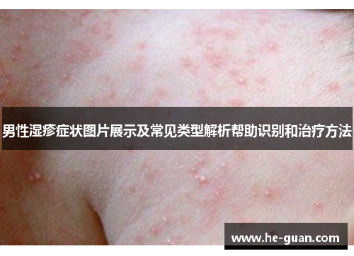 男性湿疹症状图片展示及常见类型解析帮助识别和治疗方法