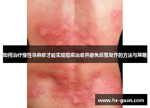 如何治疗慢性荨麻疹才能实现彻底治愈并避免反复发作的方法与策略